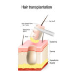 毛髪移植で移植部位の瘢痕が目立たない『ＦＵＥ』とはどのような手術なのか